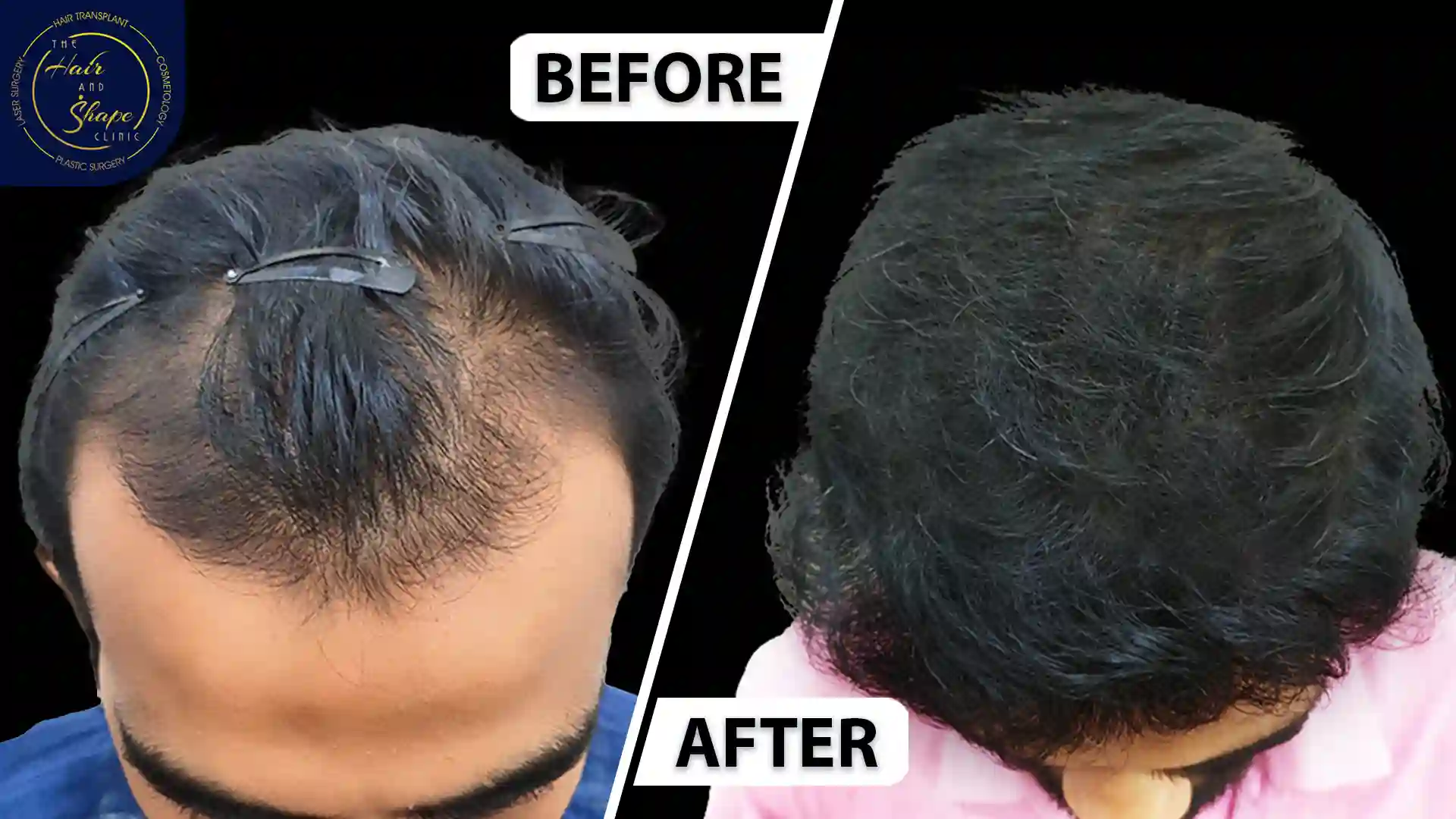 Hair Transplant result2